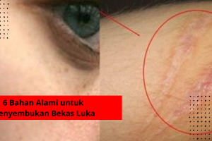 6 Bahan Alami untuk Menyembukan Bekas Luka