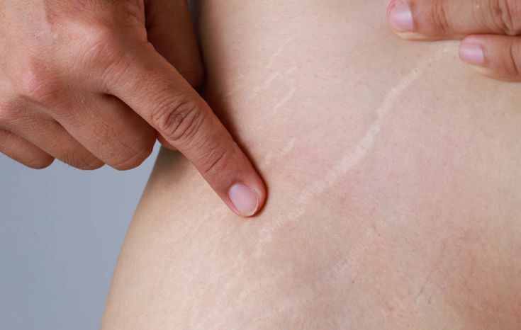 Tips Pudarkan Stretch Marks, Anda Harus Coba!