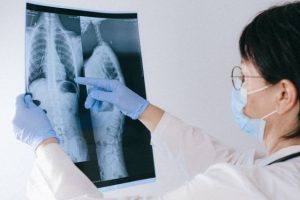 Penanganan kanker paru dengan cara Diagnosis yang tepat