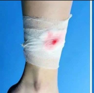 Tips Cegah Luka Diabetes Pada Kaki