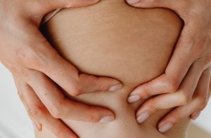 5 Alasan Mengapa Stretch Marks Muncul Begitu Saja