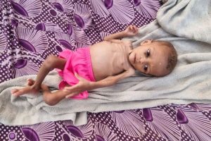 Perang Dan Kenaikan Harga, UNICEF Peringatkan ‘Bencana’ Malnutrisi Anak 