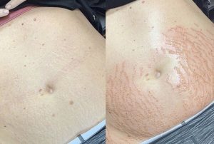 Bisakah Stretch Marks Benar-Benar Hilang hingga Tak Terlihat Sedikitpun?