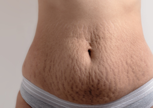 Apakah Stretch Marks Muncul Karena Kita Sering Menggaruk Permukaan Kulit?