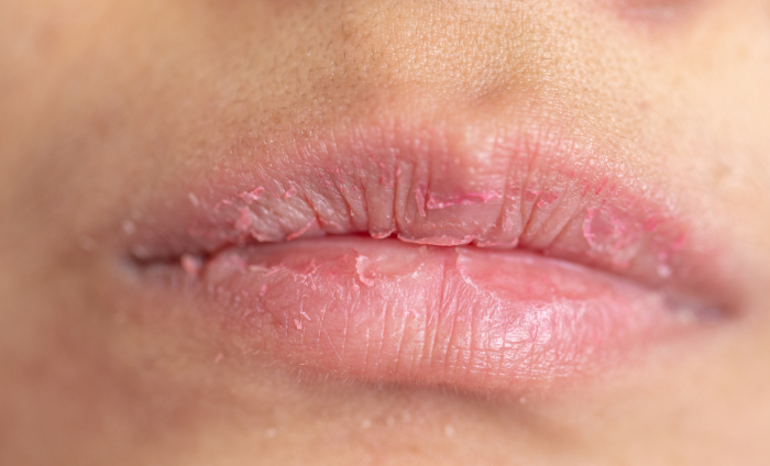 Tips Rawat dan Hindari Bibir dari Pecah-Pecah