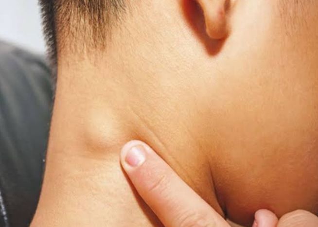 8 Cara Alami Meminimalisir Pembengkakan Kelenjar Getah Bening pada Leher