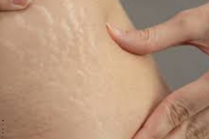 Cara Menghilangkan Stretch Mark