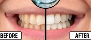 Yuk Simak Cara Alami Putihkan Gigi