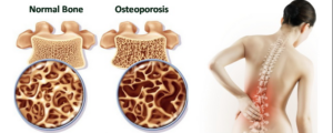 Osteoporosis: Bahaya Keroposnya Tulang pada Usia Lanjut