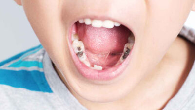 Ternyata Ini Beberapa Alasan Mengapa Anak Usia 2 Tahun Sudah Memiliki Karang Gigi