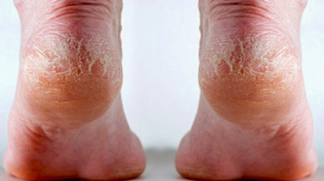 cara atasi kulit kaki gradakan (Sumber Foto. Blogspot.com)