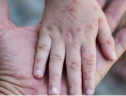 Awas! Flu Singapura Menyerang Anak-Anak