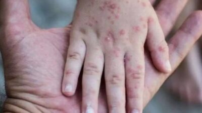 Virus flu yang berasal dari negara singapura ini sudah mulai merambah ke Indonesia, tentunya flu tersebut mendapatkan perhatian khusus