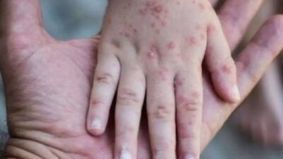 Virus flu yang berasal dari negara singapura ini sudah mulai merambah ke Indonesia, tentunya flu tersebut mendapatkan perhatian khusus