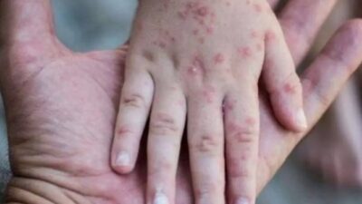 Awas! Flu Singapura Menyerang Anak-Anak