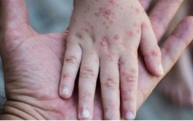 Virus flu yang berasal dari negara singapura ini sudah mulai merambah ke Indonesia, tentunya flu tersebut mendapatkan perhatian khusus